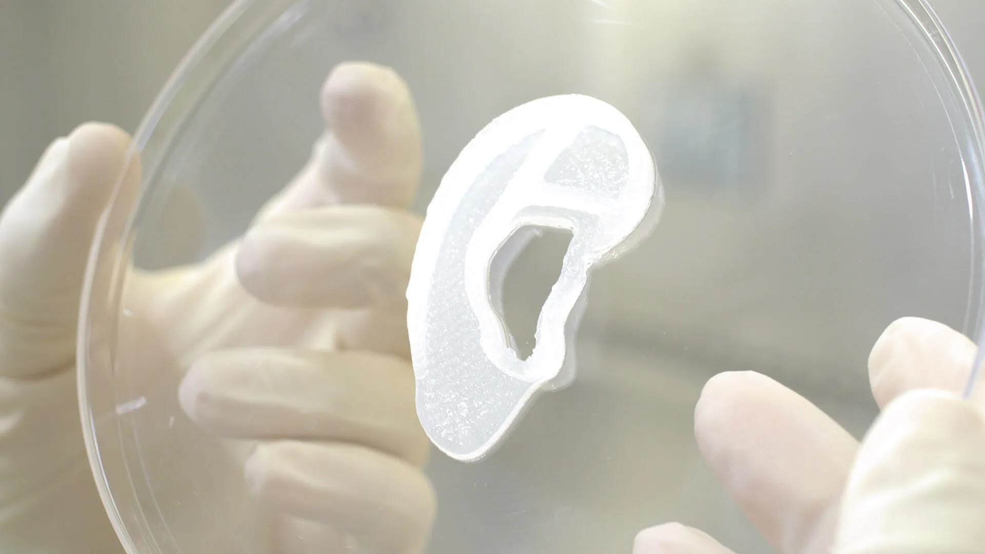 پزشکان برای اولین بار موفق به پیوند پرینت سه بعدی گوش در جهان شدند